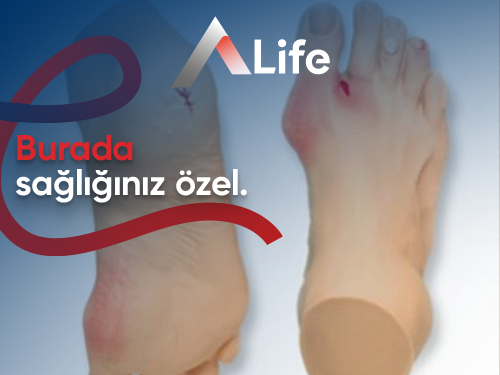 Diyabetik Ayak Amputasyonu Nedir?